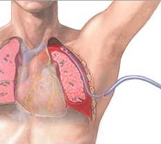 Lung Drainage